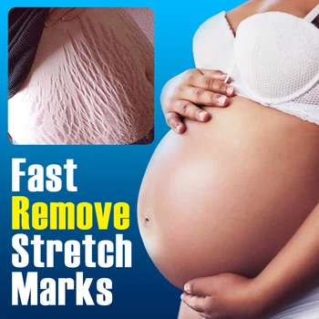 Сыворотка для удаления растяжек, быстрое восстановление, удаление шрамов от беременности, эфирное масло улитки, постоянный эффективный крем для удаления линий на теле
